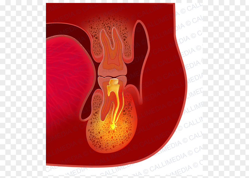 Dental Abscess Infection Periodontal Disease Tooth PNG