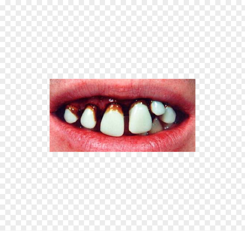 DENTIST MASK Human Tooth Dentures EBay Hillbilly PNG