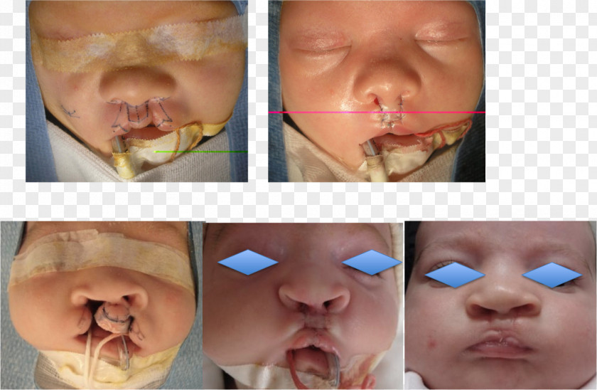Emme Anthony Cleft Lip And Palate Snout Infant Surgery PNG