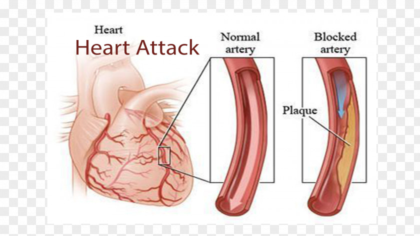 Heart Coronary Artery Disease Cardiovascular Myocardial Infarction Cardiology PNG