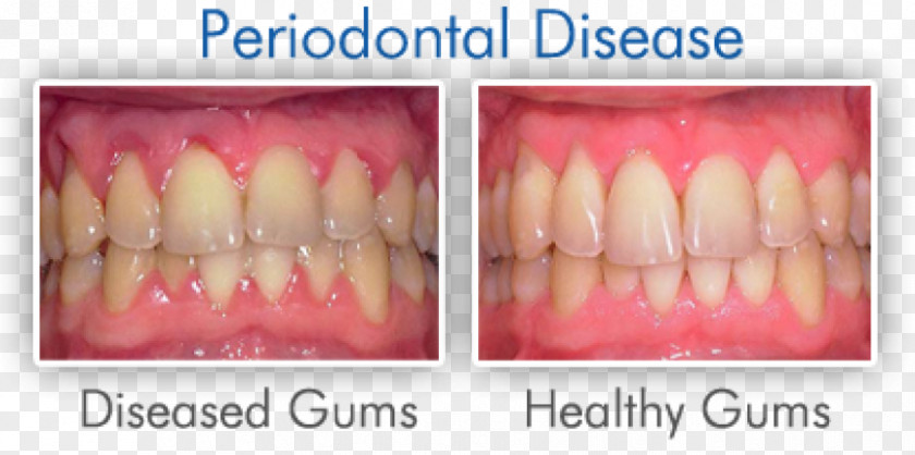 Periodontal Disease Swollen Gums Gingivitis Dentistry PNG