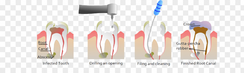 Root Canal Endodontic Therapy Dentistry PNG