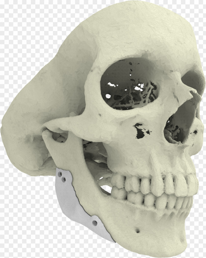 3d Printed Mandible 3D Printing Implant Xilloc Bone PNG