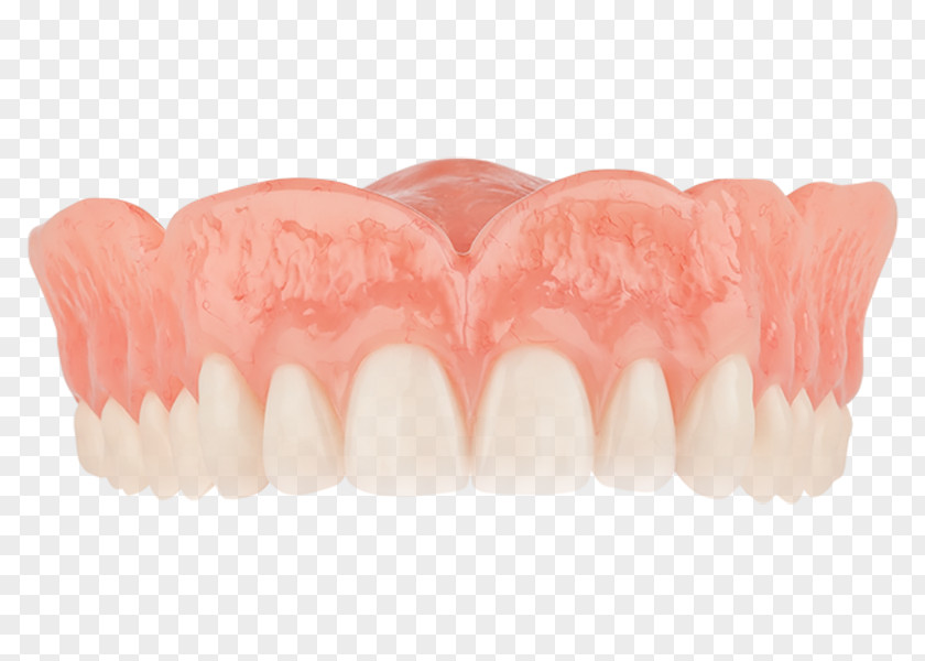 Crown Dentures Tooth Dentistry Removable Partial Denture PNG
