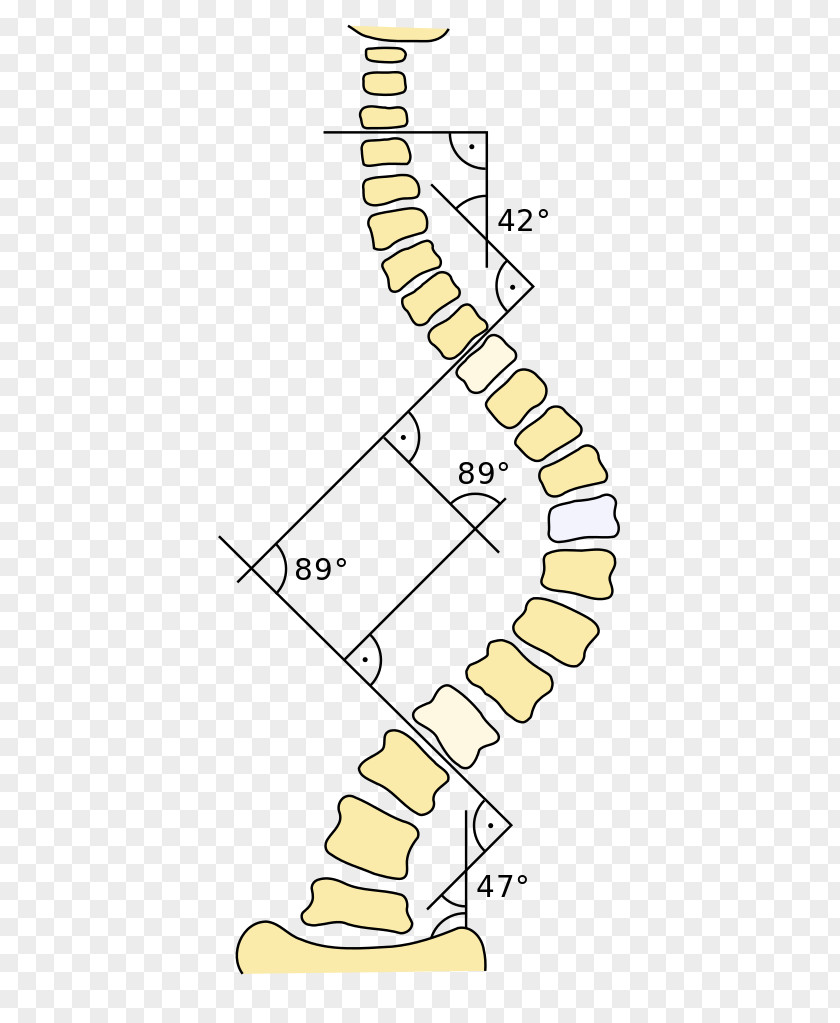 Scoliosis Cobb Angle Three-Dimensional Treatment For Scoliosis: A Physiotherapeutic Method Deformities Of The Spine Kyphosis Disease PNG