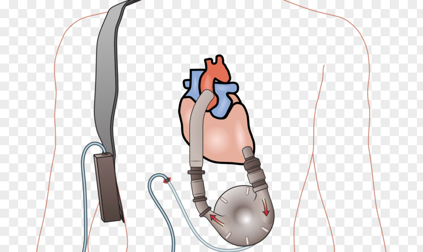 Heart Ventricular Assist Device Transplantation Ventricle Failure PNG