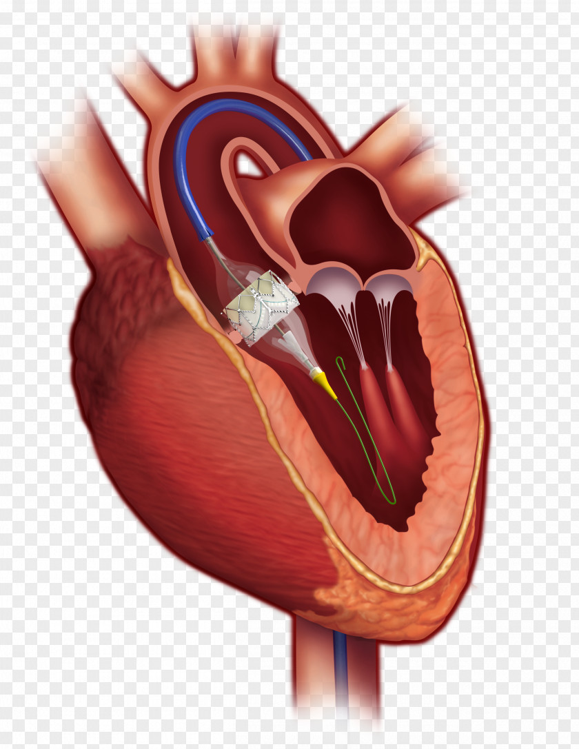 Heart Percutaneous Aortic Valve Replacement Stenosis PNG