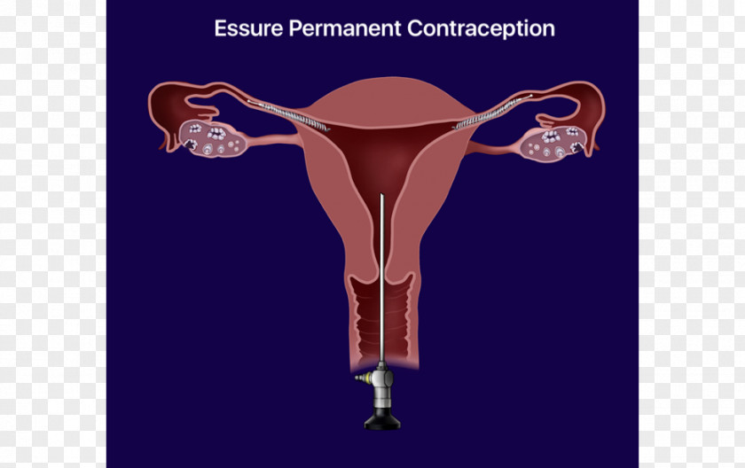 Essure Birth Control Sterilization Intrauterine Device Copper IUDs PNG