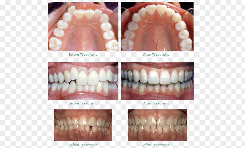 Front Teeth Dentistry Human Tooth Dental Braces Clear Aligners PNG