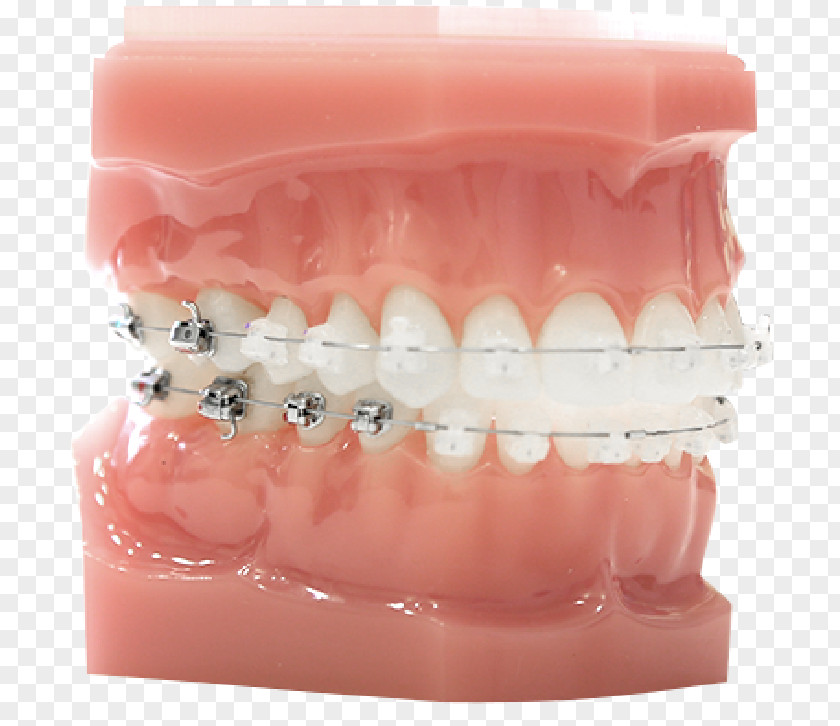 Damon Tooth System Dental Braces Dentistry ファミリエ歯科クリニック PNG