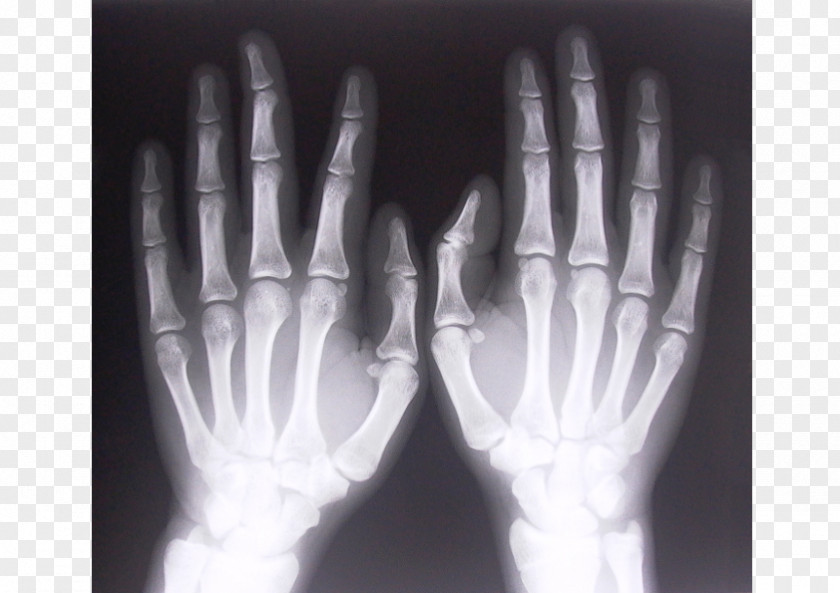 Backscatter X-ray Rheumatoid Arthritis Joint PNG