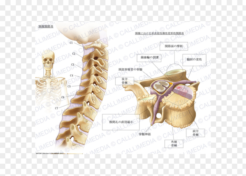 Cervical Collar Osteoarthritis Vertebrae Pain PNG