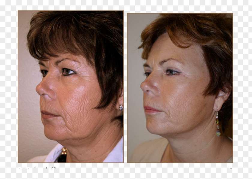 Face Cheek Rhytidectomy Lifestyle Lift Chin PNG