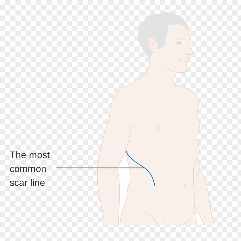 Lungs Surgery Thumb Drawing Scar PNG