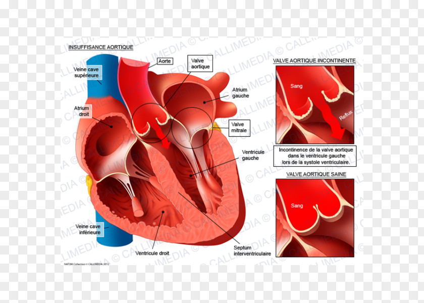 Heart Aortic Insufficiency Valvular Stenosis Valve Aorta Mitral PNG