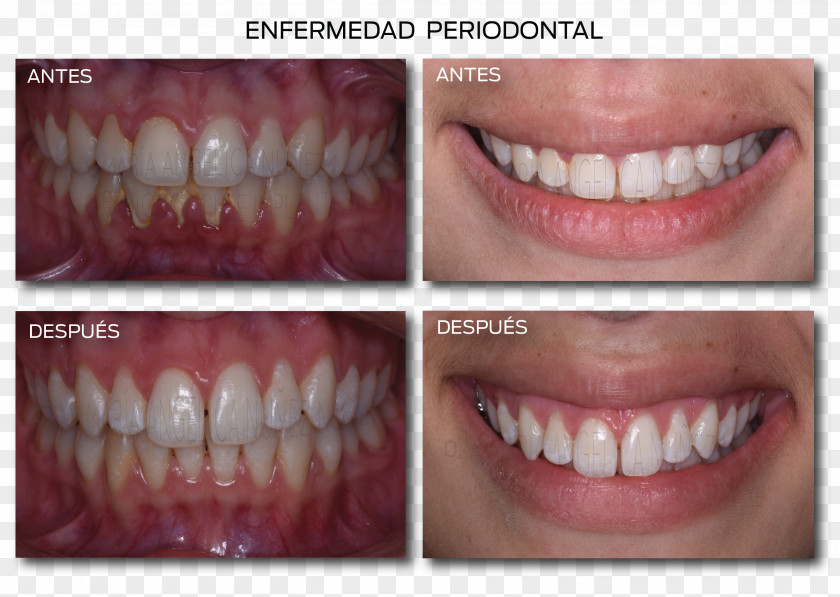 Gum Disease Tooth List Of Periodontal Diseases Gums Gingivitis PNG