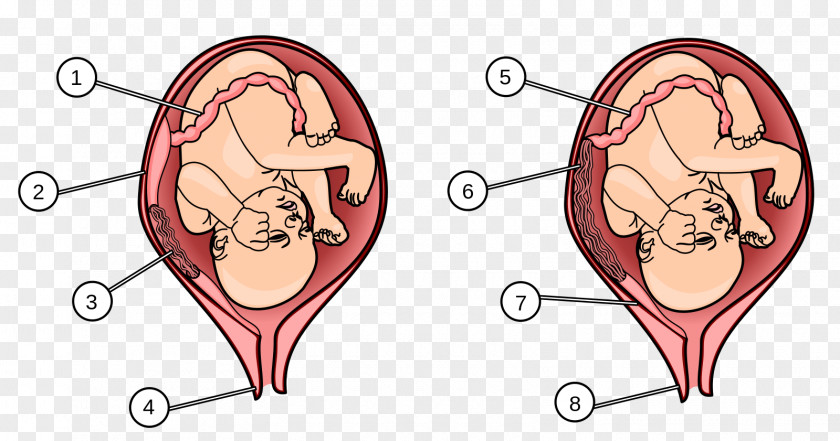 Part Of Female Reproductive System Placenta Praevia Human Fetus Uterus PNG