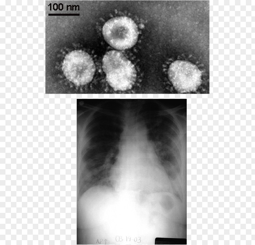 Pneumonia Pathophysiology Middle East Respiratory Syndrome Coronavirus Severe Acute Coronaviridae PNG