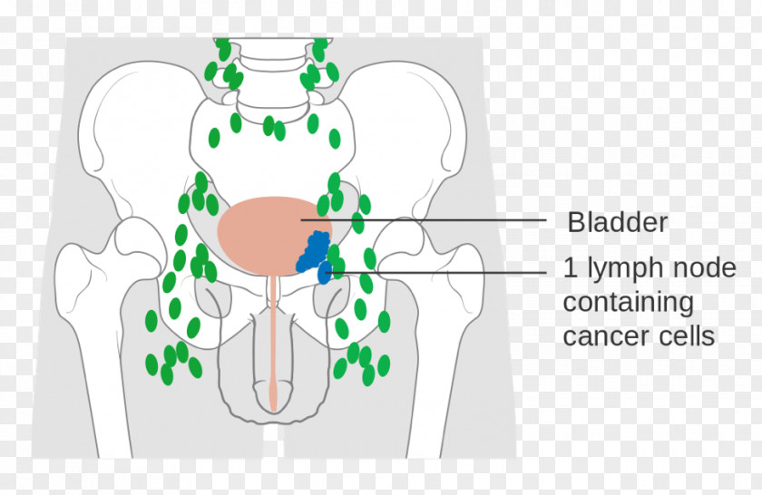 Bladder Cancer Urinary Staging Carcinoma PNG