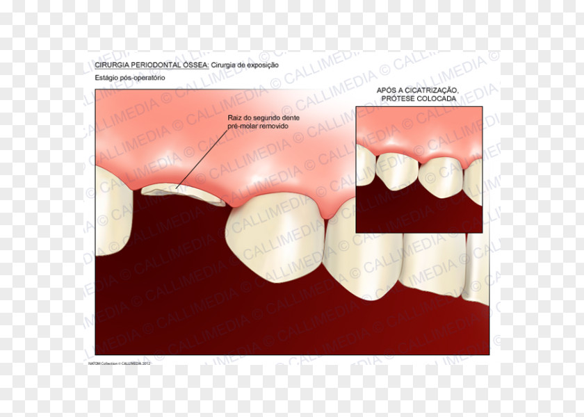 Crown Tooth Lengthening Dentistry Surgery PNG