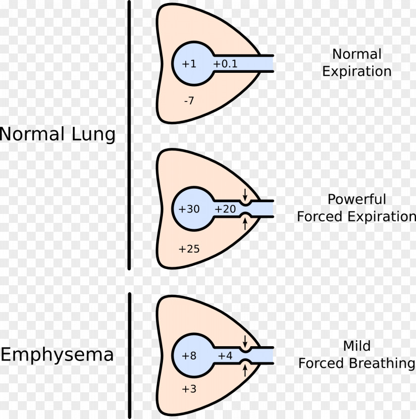 Dynamic Compression Of The Airways Lung Pulmonary Compliance Pursed Lip Breathing PNG