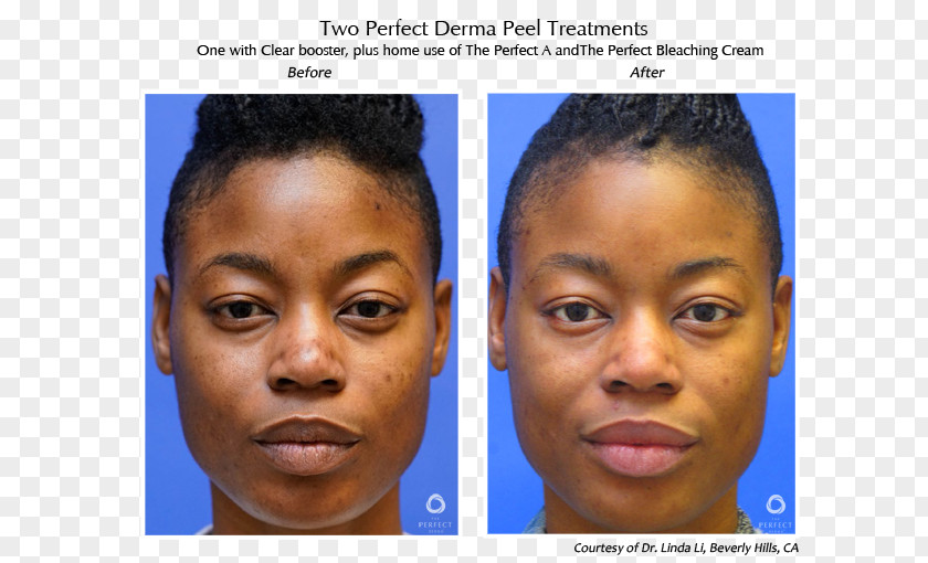 Skin Care Model Chemical Peel Dermis The Perfect Derma Face PNG