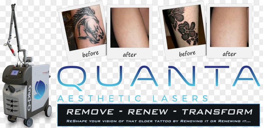 Flashpoint Tattoo Company Removal Laser Cover-up PNG
