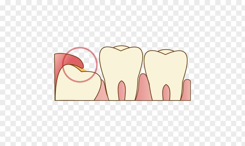 Shiraz Wisdom Tooth Dentist 歯科 Dental Extraction PNG