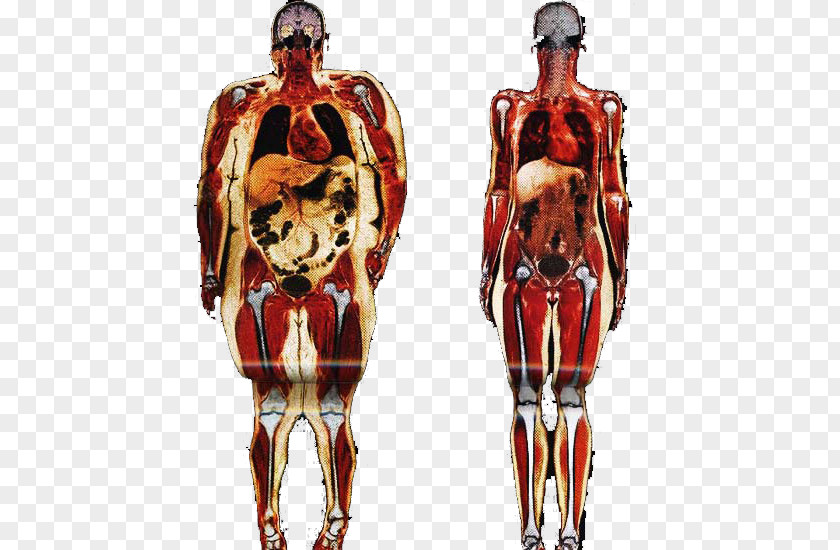 Health Obesity Human Body Adipose Tissue Anatomy Connective PNG