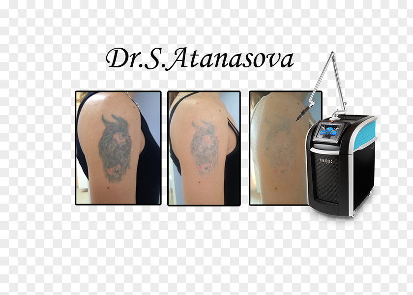 Remova Ata-derma 0 Dermatology Tattoo Bulevard 