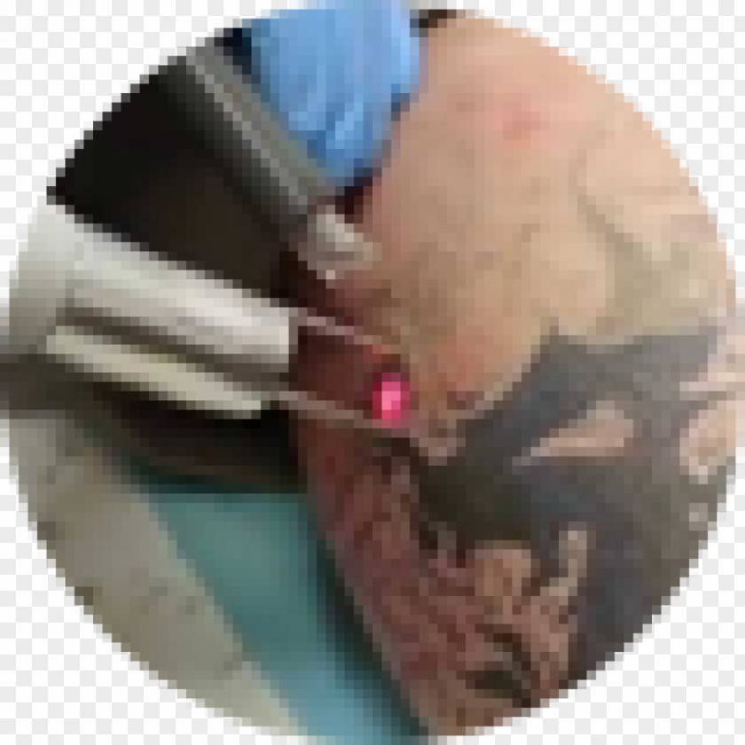 Tattoo Removal Artist Permanent Makeup Laser PNG