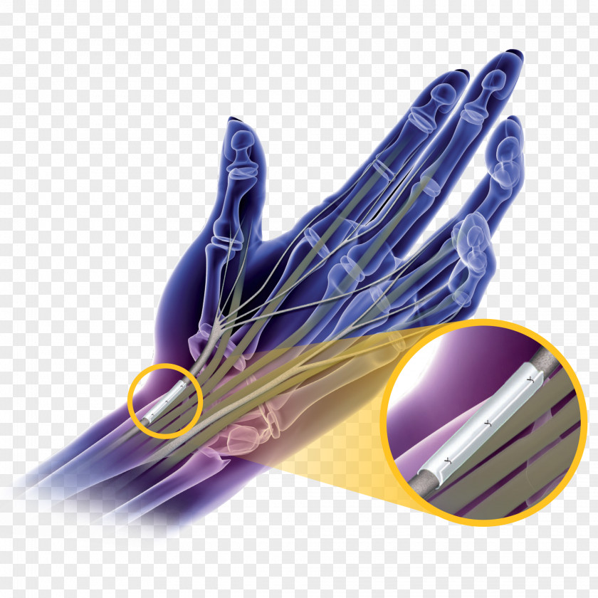 Hand Carpal Tunnel Syndrome Surgery Nerve PNG