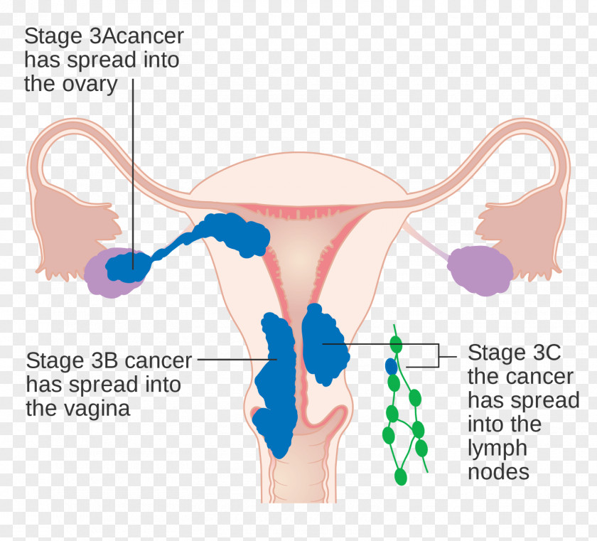 Nettle Uterine Cancer Endometrial Endometrium Staging PNG