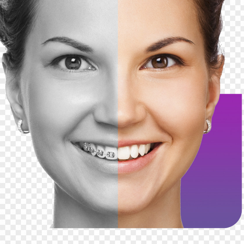 Smile Элайнер Dental Braces Tooth Jaw PNG