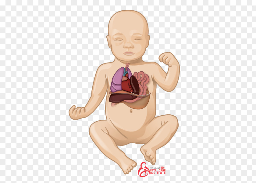 Pulmonary Hypoplasia Congenital Airway Malformation Diaphragmatic Hernia Lung PNG