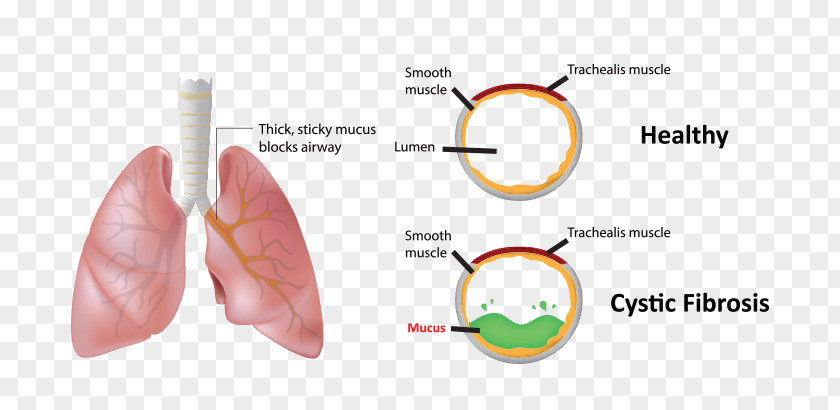 Blood Mucus Hemoptysis Cystic Fibrosis Nose PNG