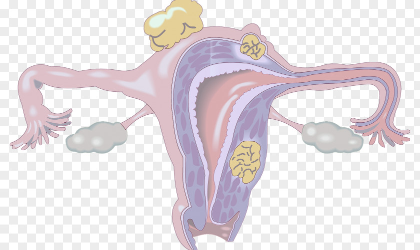 Health Uterine Fibroid Myoma Gynaecology Benignity Benign Tumor PNG