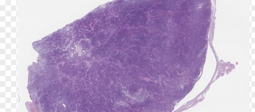 Pathology Metastasis Information Neoplasm PNG