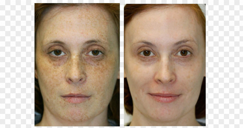 Face Liver Spot Eyebrow Skin Photorejuvenation PNG