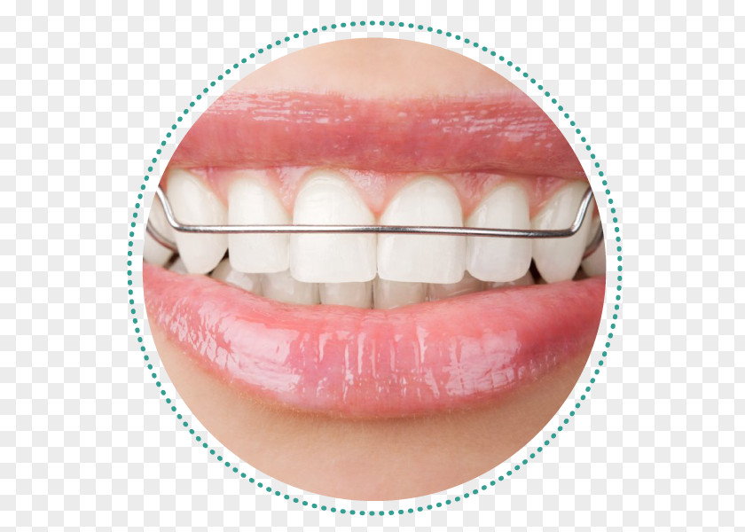 Bridge Orthodontics Dental Braces Dentistry Retainer PNG
