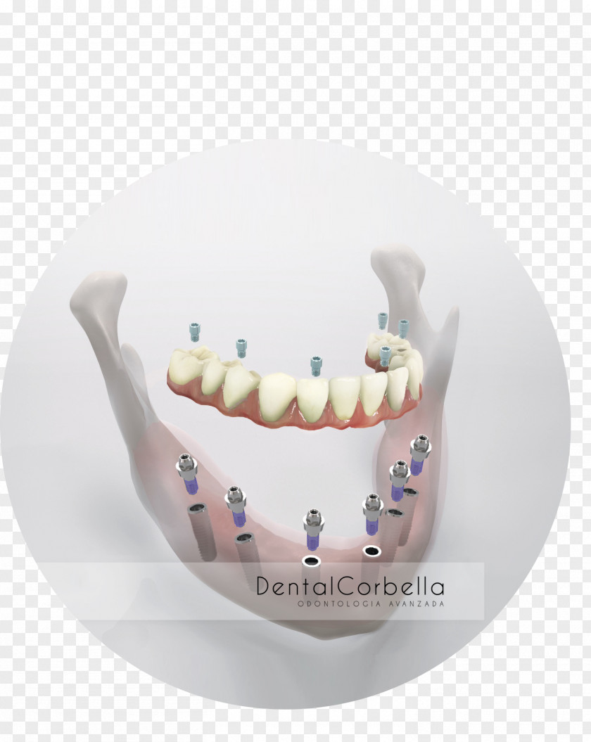 Cirujano Dentista Implantes Human Tooth Dental Implant Dentistry Dentures PNG