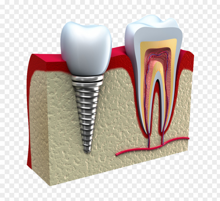 Teeth Dental Implant Dentistry Restoration PNG