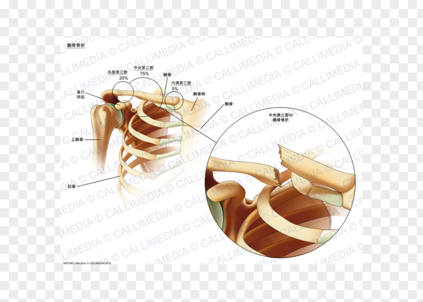 Fracture Clavicle Bone Sternum PNG