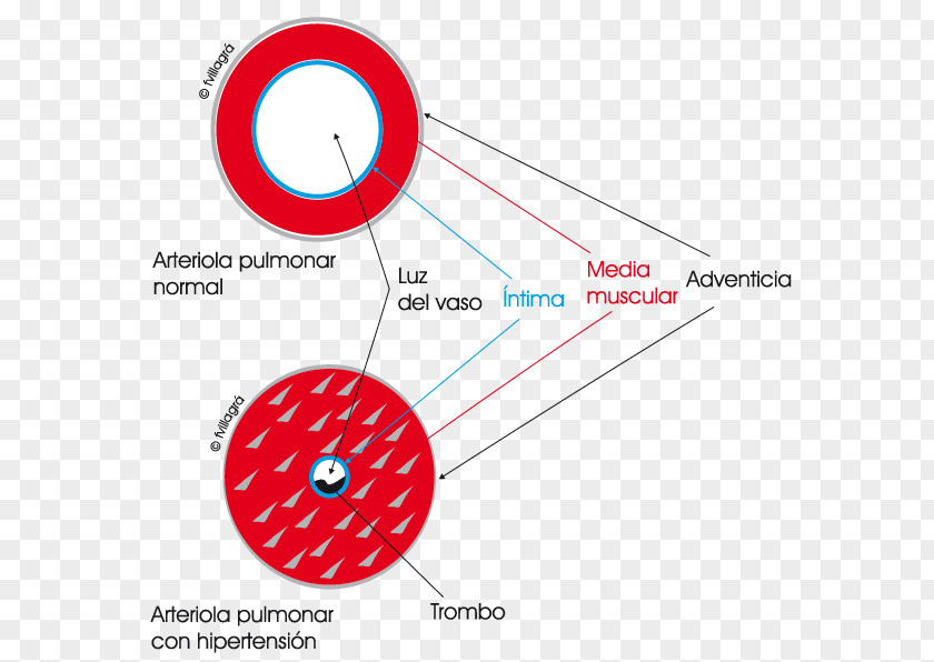 Blood Pressure Lung Pulmonary Artery Hypertension Shunt PNG