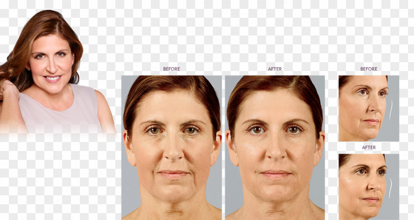 Nose Eyebrow Injectable Filler Non-surgical Rhinoplasty PNG