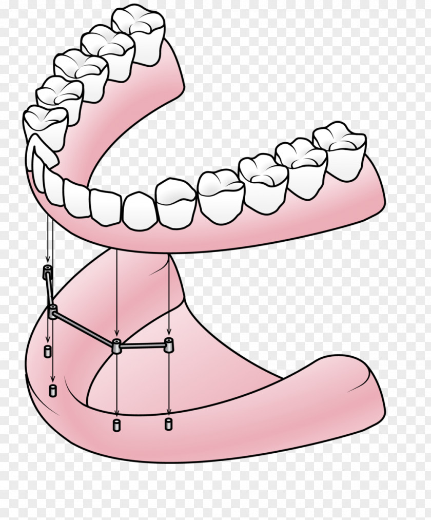 Dental Implant Dentures Dentistry All-on-4 PNG