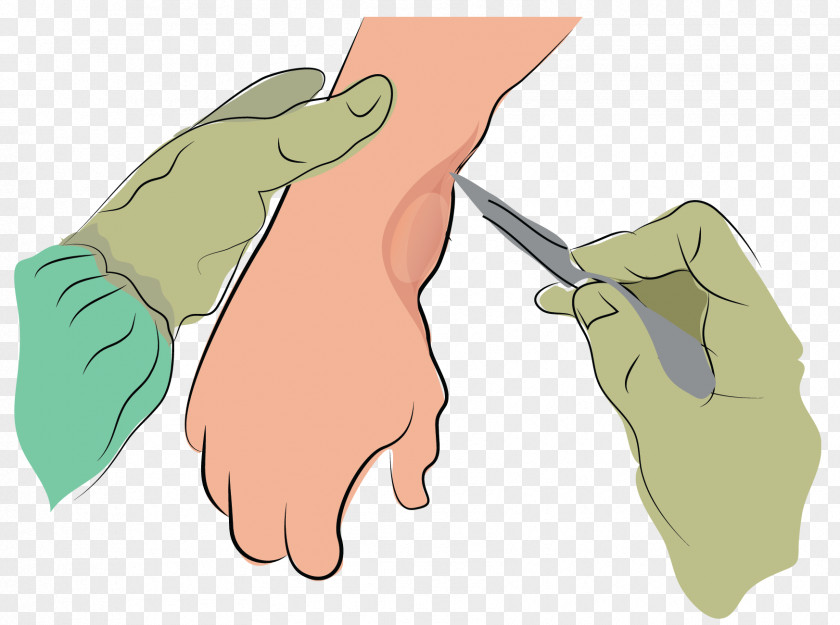 Syringe Synovial Cyst Finger Joint Fluid PNG