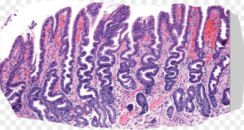 Foveolar Cell Reactive Gastropathy Hyperplasia Pathology PNG
