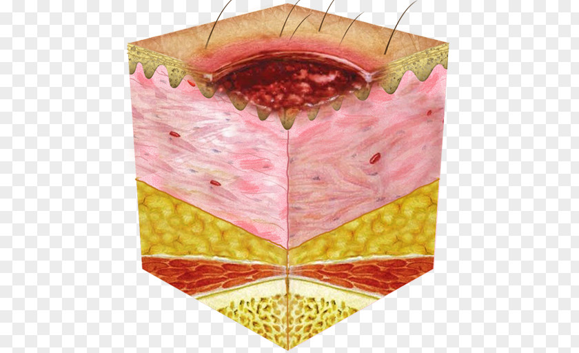 Ulcer Bed Sore Pressure Eschar Preventive Healthcare Skin PNG