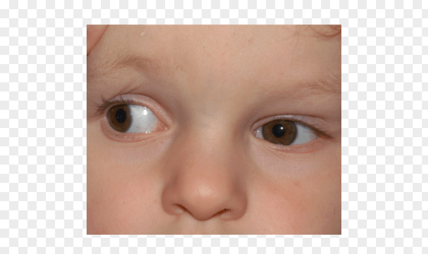 Eye Duane Syndrome Movement Differential Diagnosis PNG